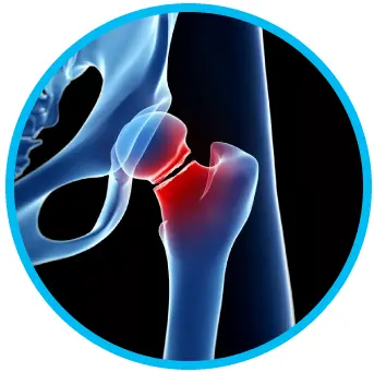 Secuelas de Fracturas